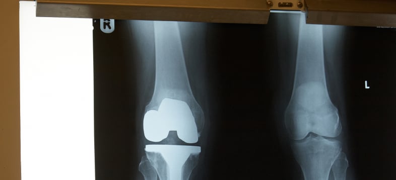 juvenile rheumatoid arthritis x-ray